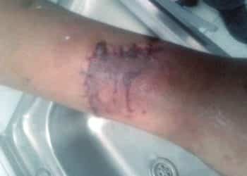 Caminaba por la plaza Integración y lo mordió un dogo argentino en Huincul